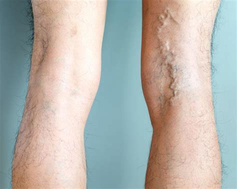 big bulging|5 Causes For Bulging Veins and Why You Should Treat Them.